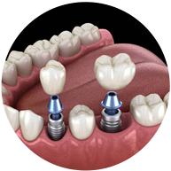 implantes dentales implantd el bordo